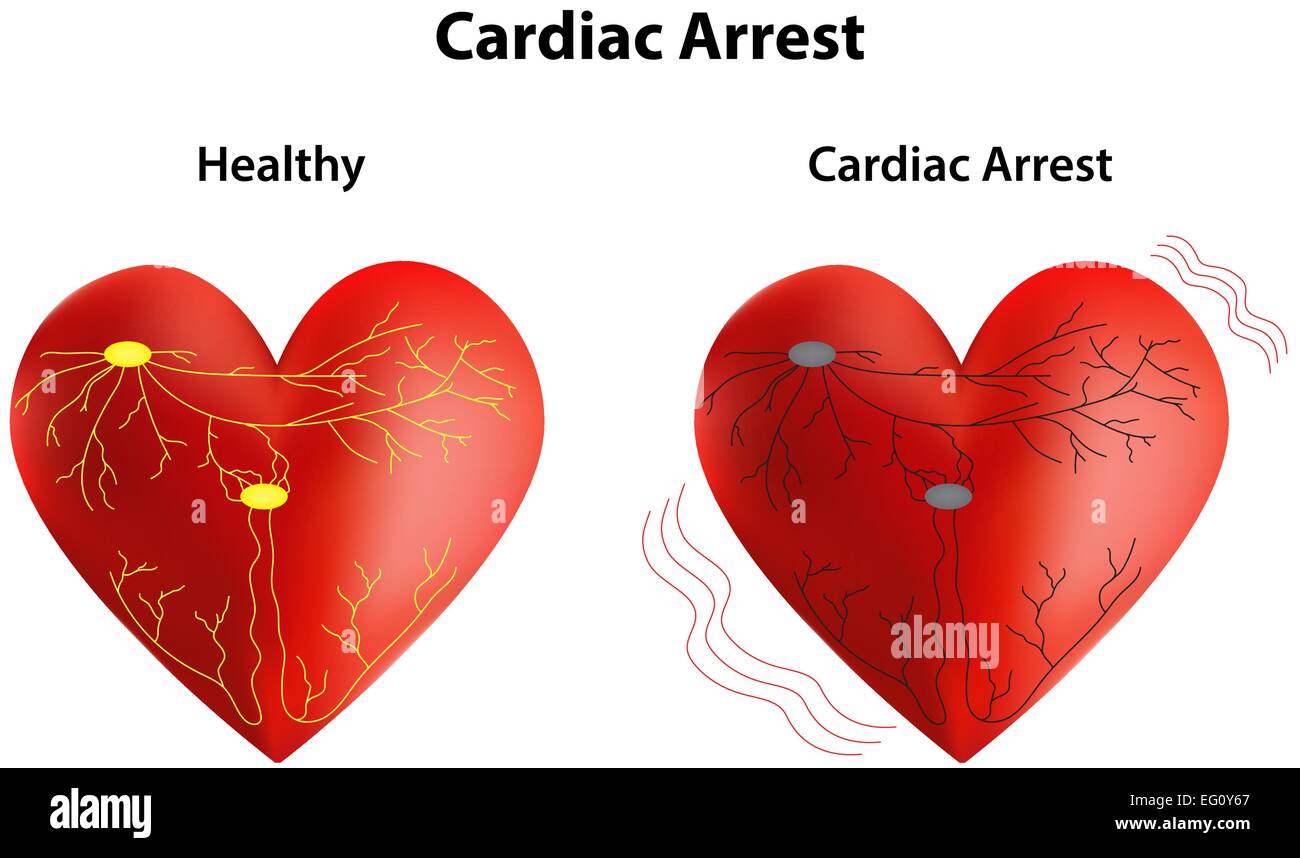 Arresto cardiaco Illustrazione Vettoriale