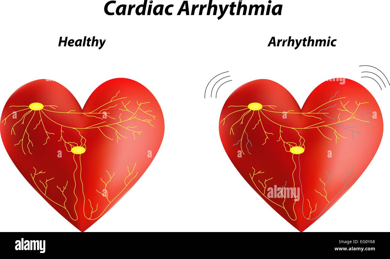 Aritmia cardiaca Illustrazione Vettoriale