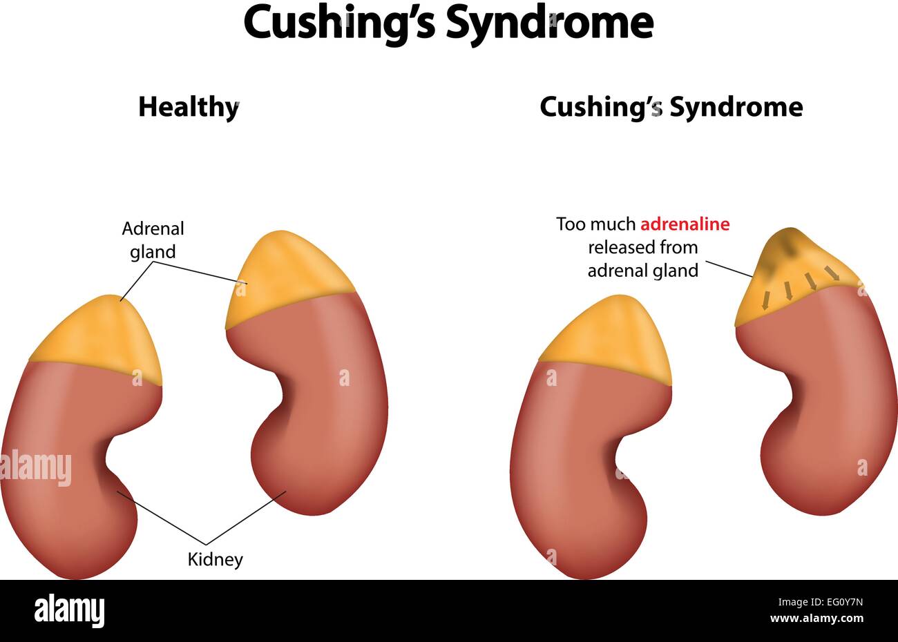 viso sindrome di cushing immagini