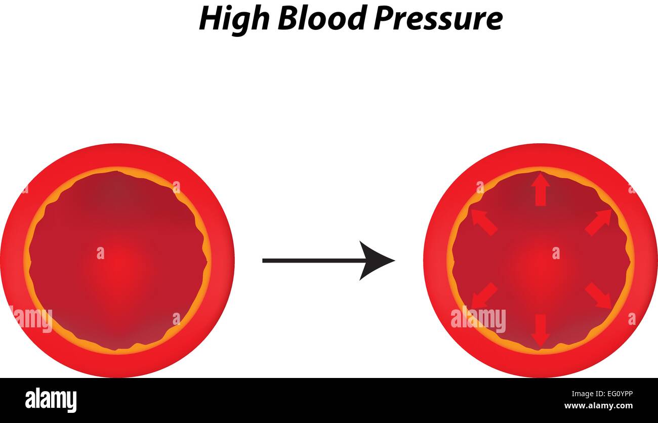 Alta pressione sanguigna Illustrazione Vettoriale