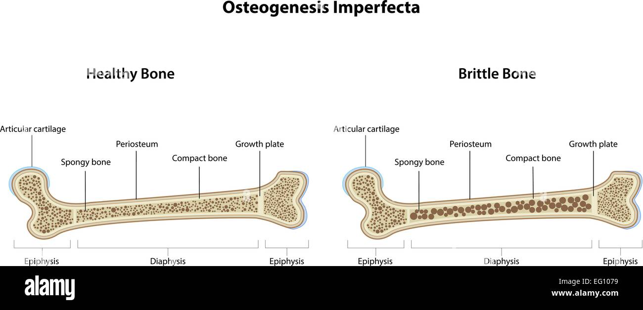 Osteogenesi imperfetta Illustrazione Vettoriale