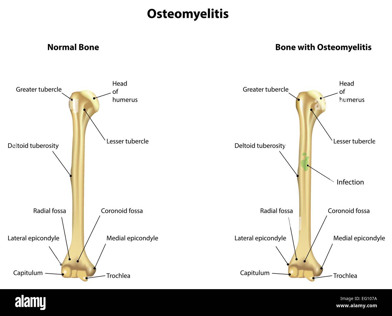 Osteomielite Illustrazione Vettoriale