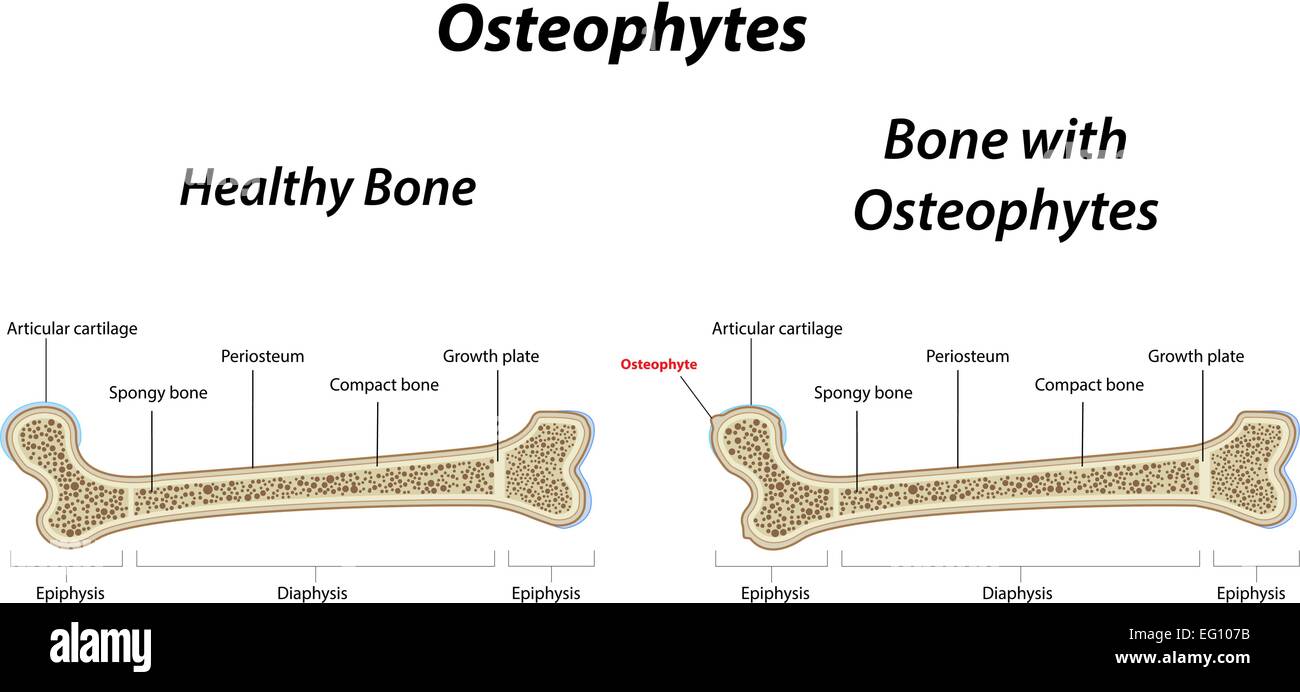 Osteofiti Illustrazione Vettoriale