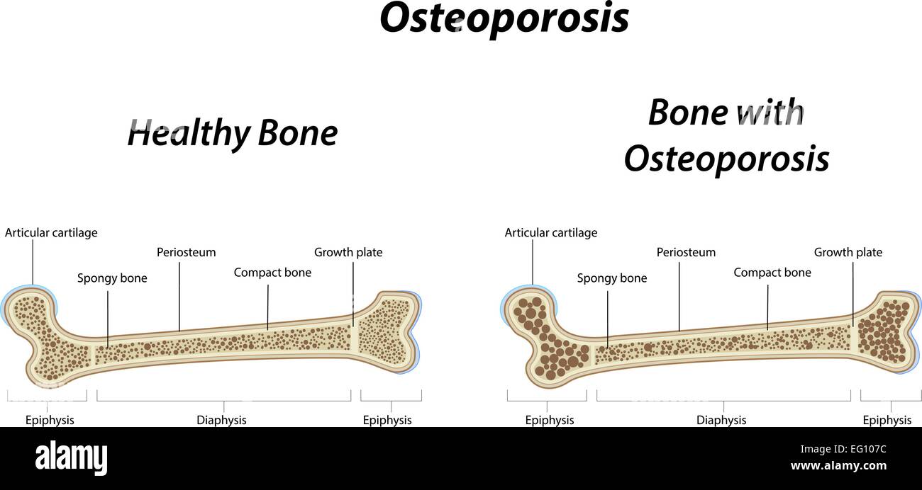 Osteoporosi Illustrazione Vettoriale