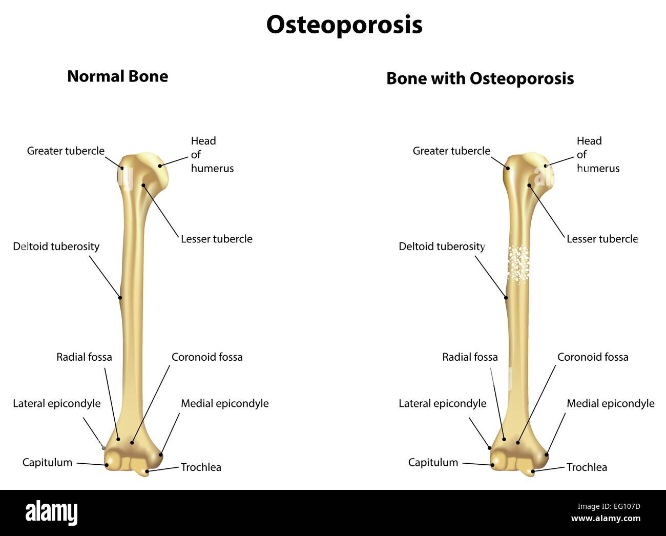 Osteoporosi Illustrazione Vettoriale