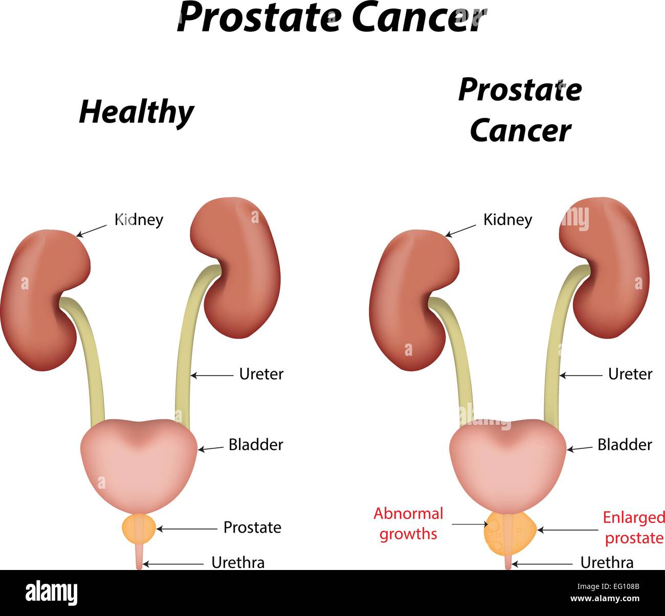 Carcinoma della prostata Illustrazione Vettoriale