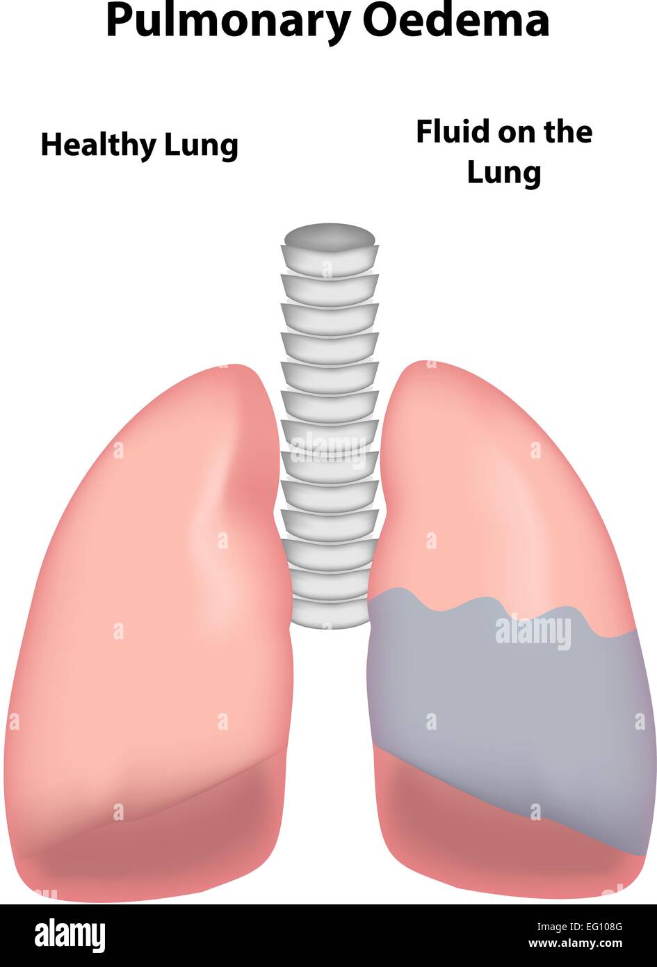 Edema polmonare Illustrazione Vettoriale