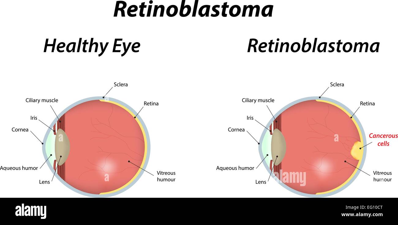 Retinoblastoma Illustrazione Vettoriale