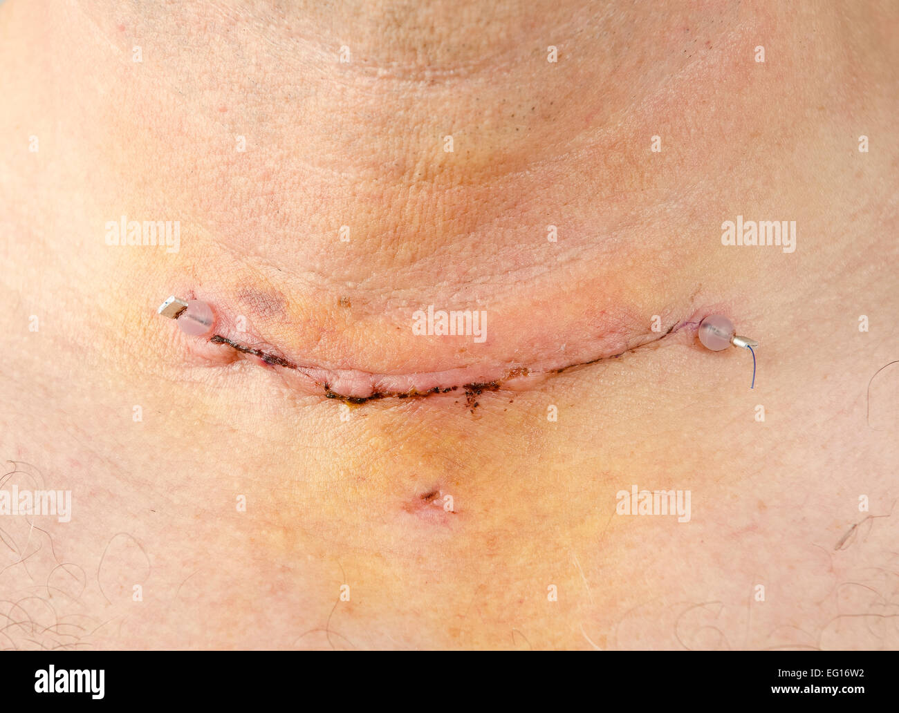 Post operatoria cicatrice avvolto e la cucitura di thyroidectomy mostrando anche dove scaricare è stata inserita release disponibile per determinati usi Foto Stock