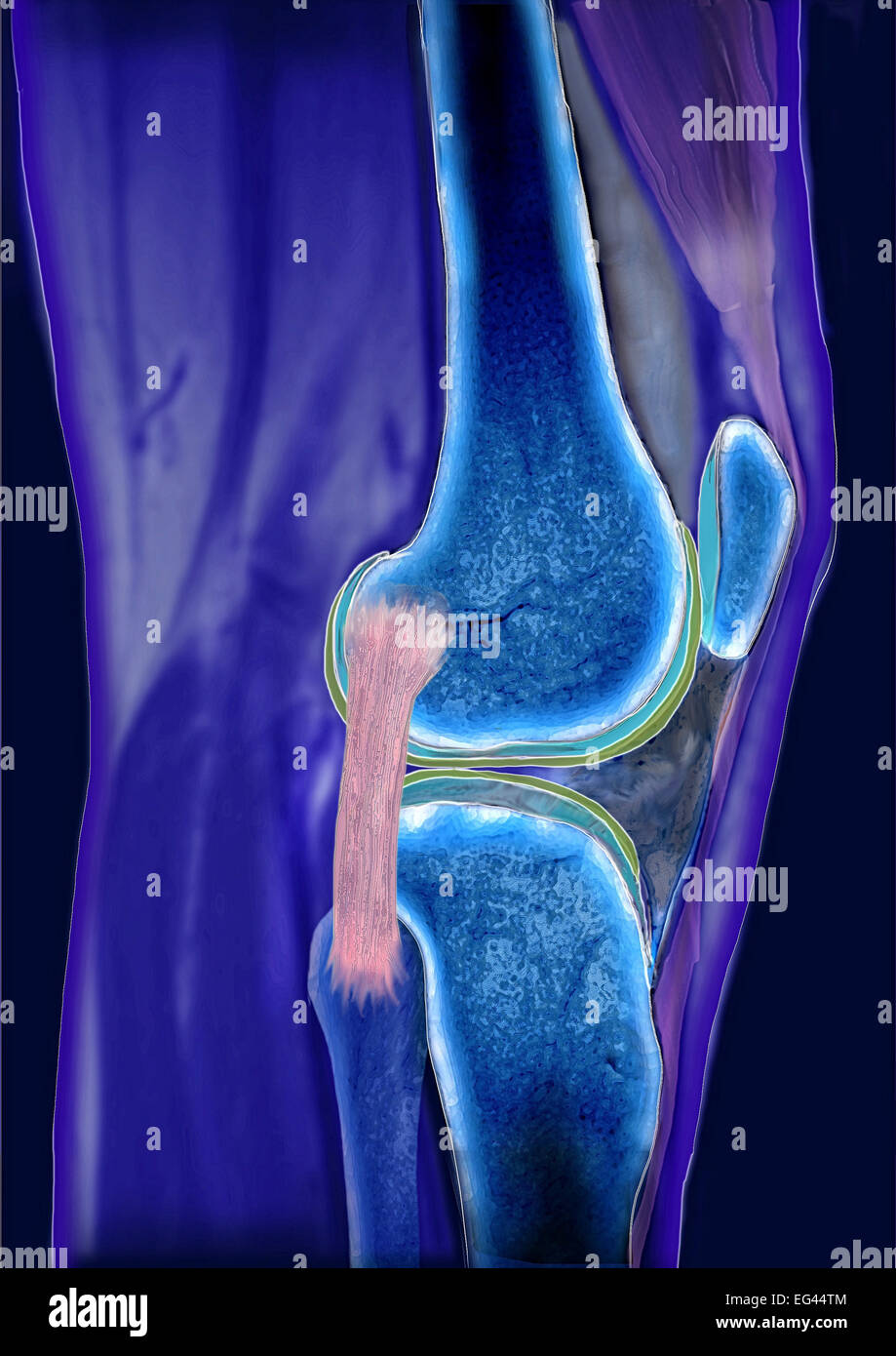 Ginocchio genere Articulatio, legamento collaterale, tomografia computerizzata Foto Stock