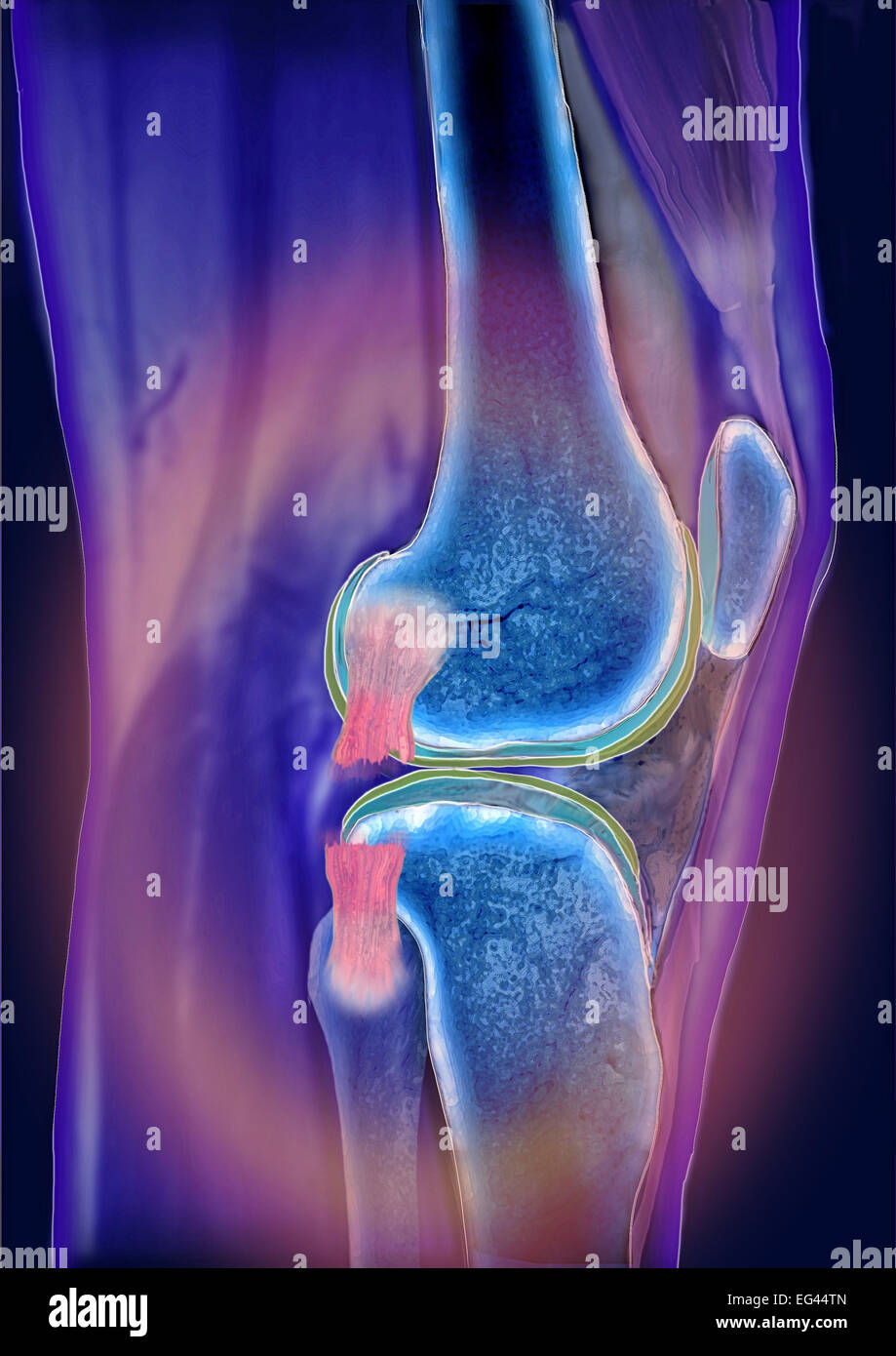 Ginocchio genere Articulatio, laterale legamento collaterale pregiudizio, tomografia computerizzata Foto Stock