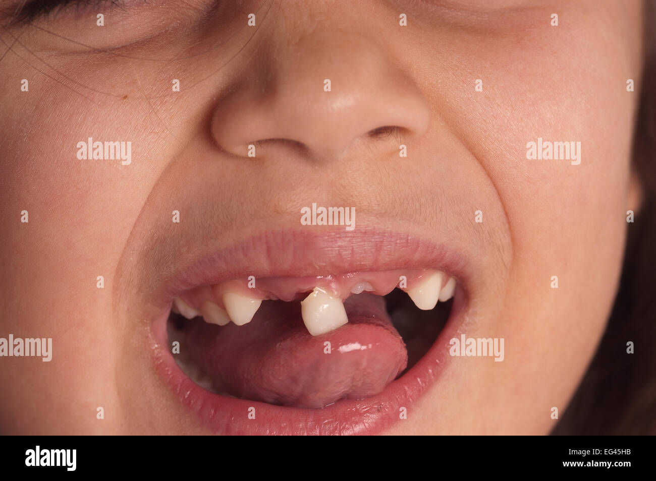 7 anno vecchia ragazza felice crescendo e fatto circa perdere ultimo traballanti rimanenti dente anteriore i denti di latte di cadere fuori Foto Stock