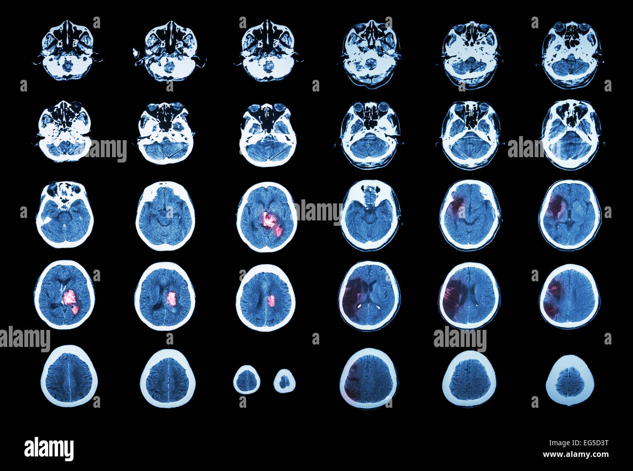 Ictus emorragico e ictus ischemico . Scansione TC del cervello : emorragia intracerebrale ( 3 colonna sinistra , infarto cerebrale ( 3 Foto Stock