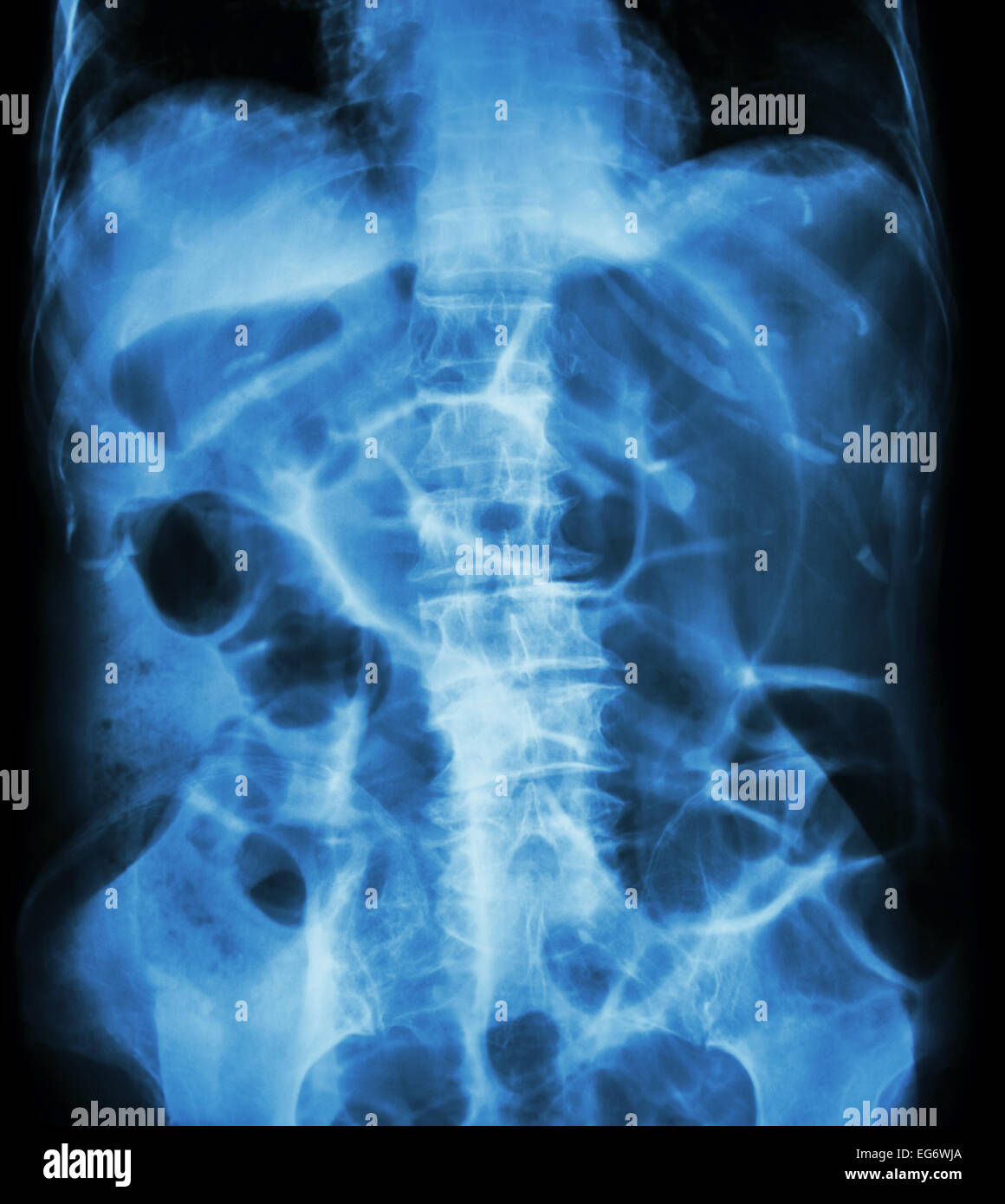 Occlusione intestinale ( X-ray addome posizione supina : il grosso  intestino si dilatano a causa di intestino crasso ostruzione a causa di  cancro al colon Foto stock - Alamy