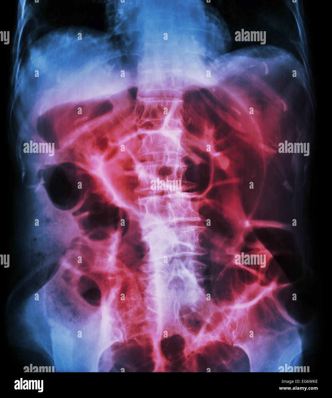Occlusione intestinale ( X-ray addome posizione supina : il grosso intestino si dilatano a causa di intestino crasso ostruzione a causa di cancro al colon) Foto Stock