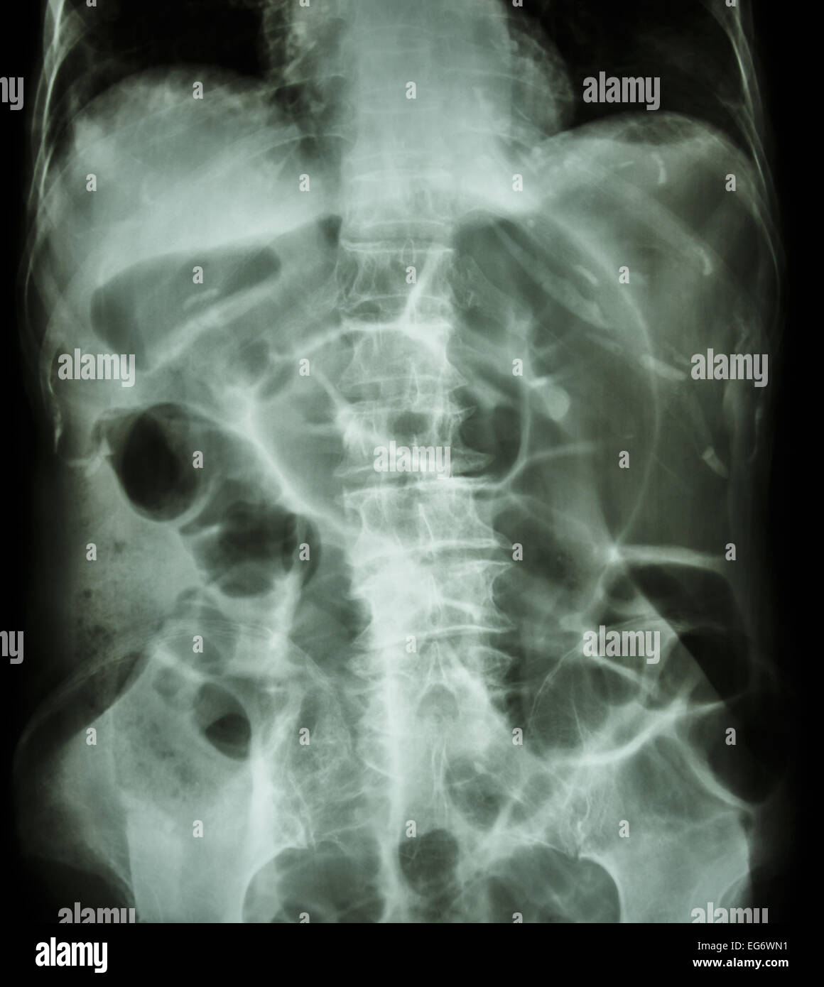 Occlusione intestinale ( X-ray addome posizione supina : il grosso intestino si dilatano a causa di intestino crasso ostruzione a causa di cancro al colon) Foto Stock