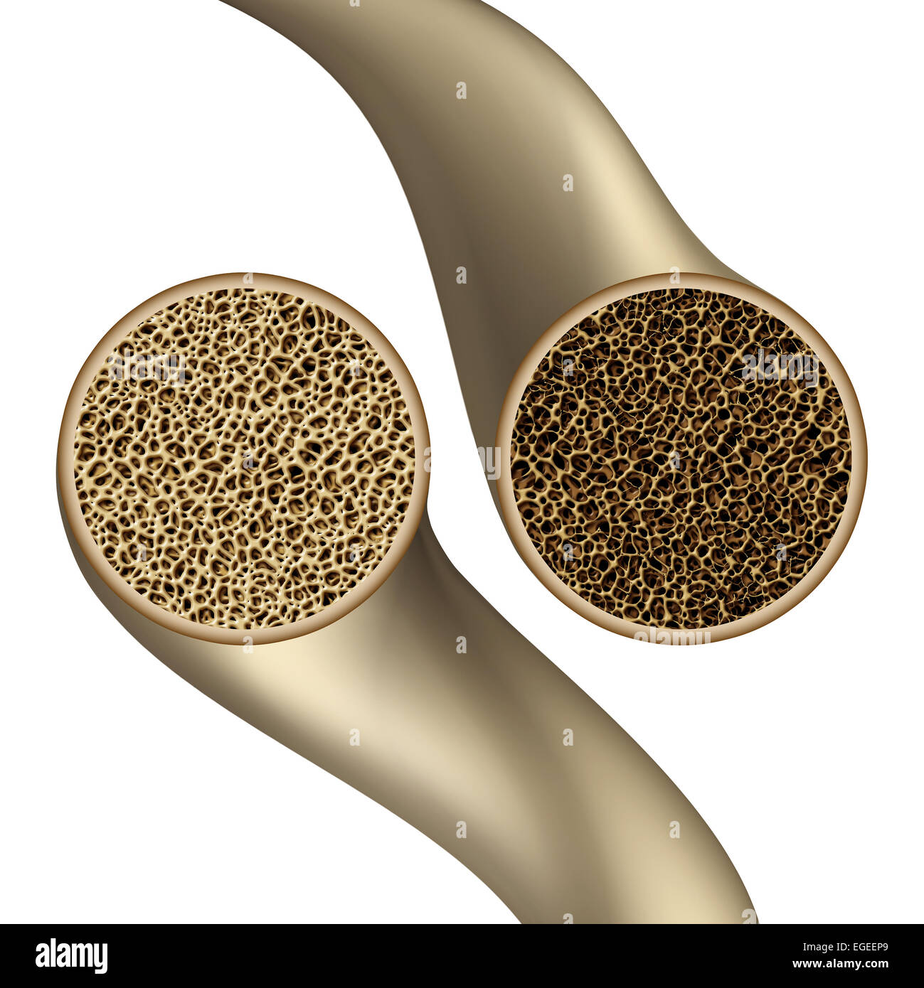 La salute delle ossa simbolo come un medico di osteoporosi concetto illustrazione che mostra un ingrandimento del confronto umano le ossa dello scheletro di una sana e malsano anatomia poroso. Foto Stock