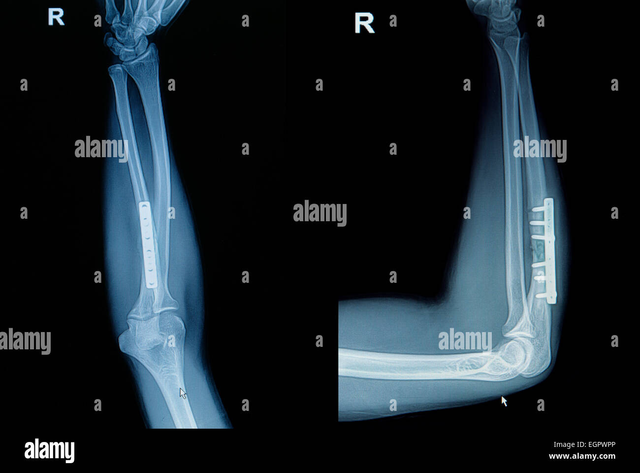 Film x-ray frattura al polso : Visualizza raggio di frattura ossea (avambraccio di osso) con inserita la piastra che la vite Foto Stock