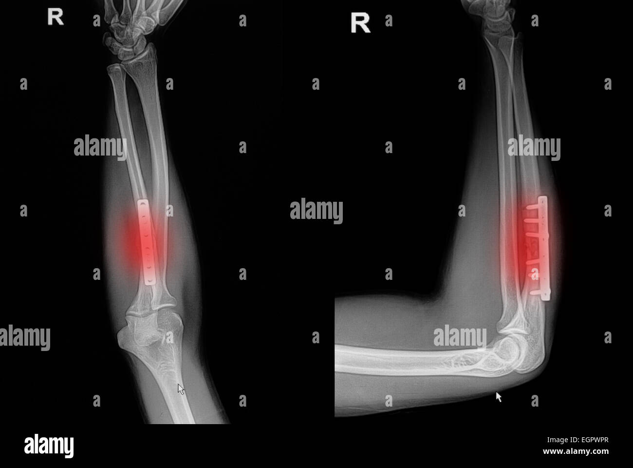 Film x-ray avambraccio frattura : Visualizza raggio di frattura ossea (avambraccio di osso) con inserita la piastra che la vite Foto Stock