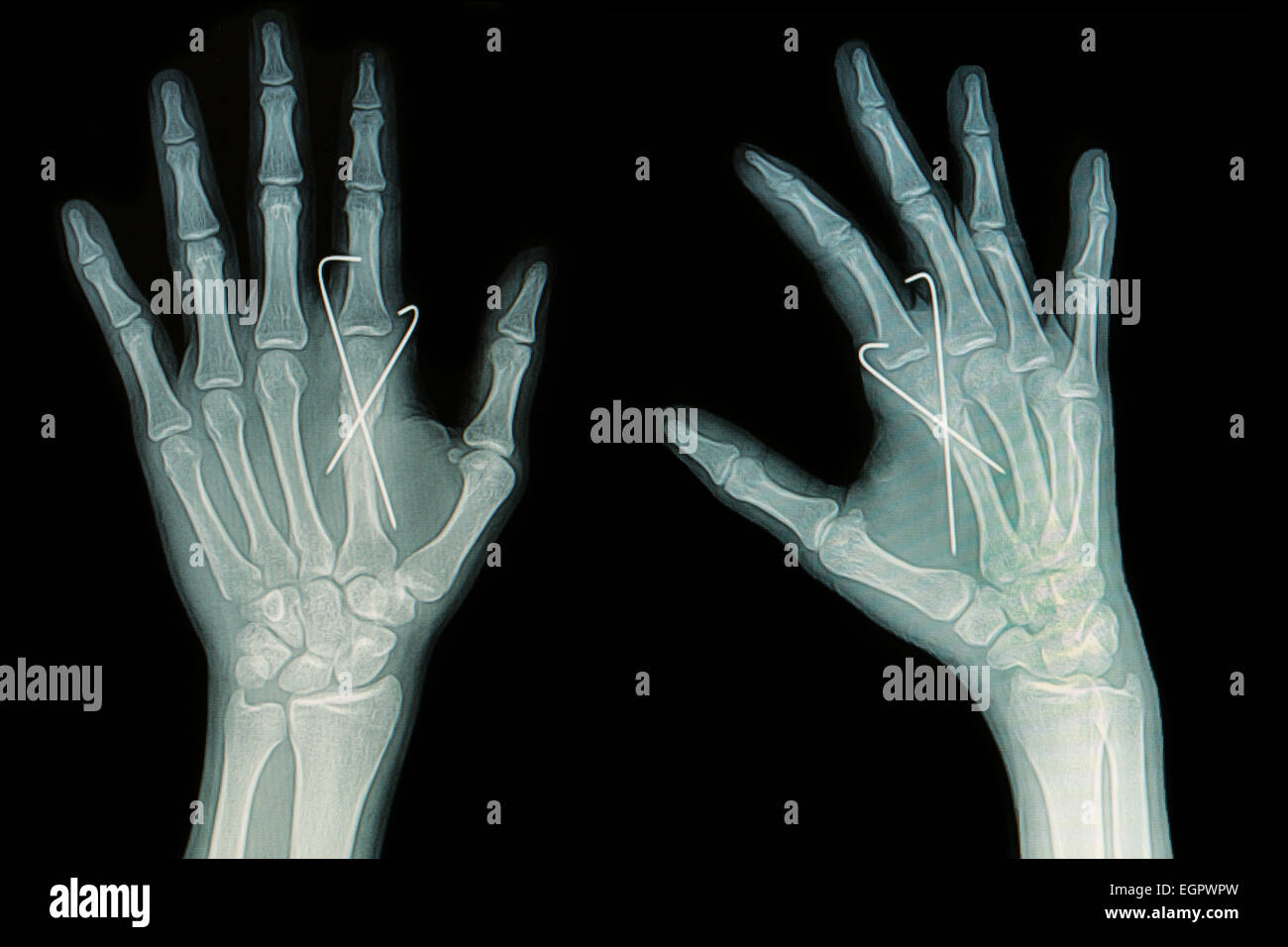 Film x-ray di mano frattura : mostra la frattura ossa metacarpali inserto  con k-filo (filo di Kirschner Foto stock - Alamy
