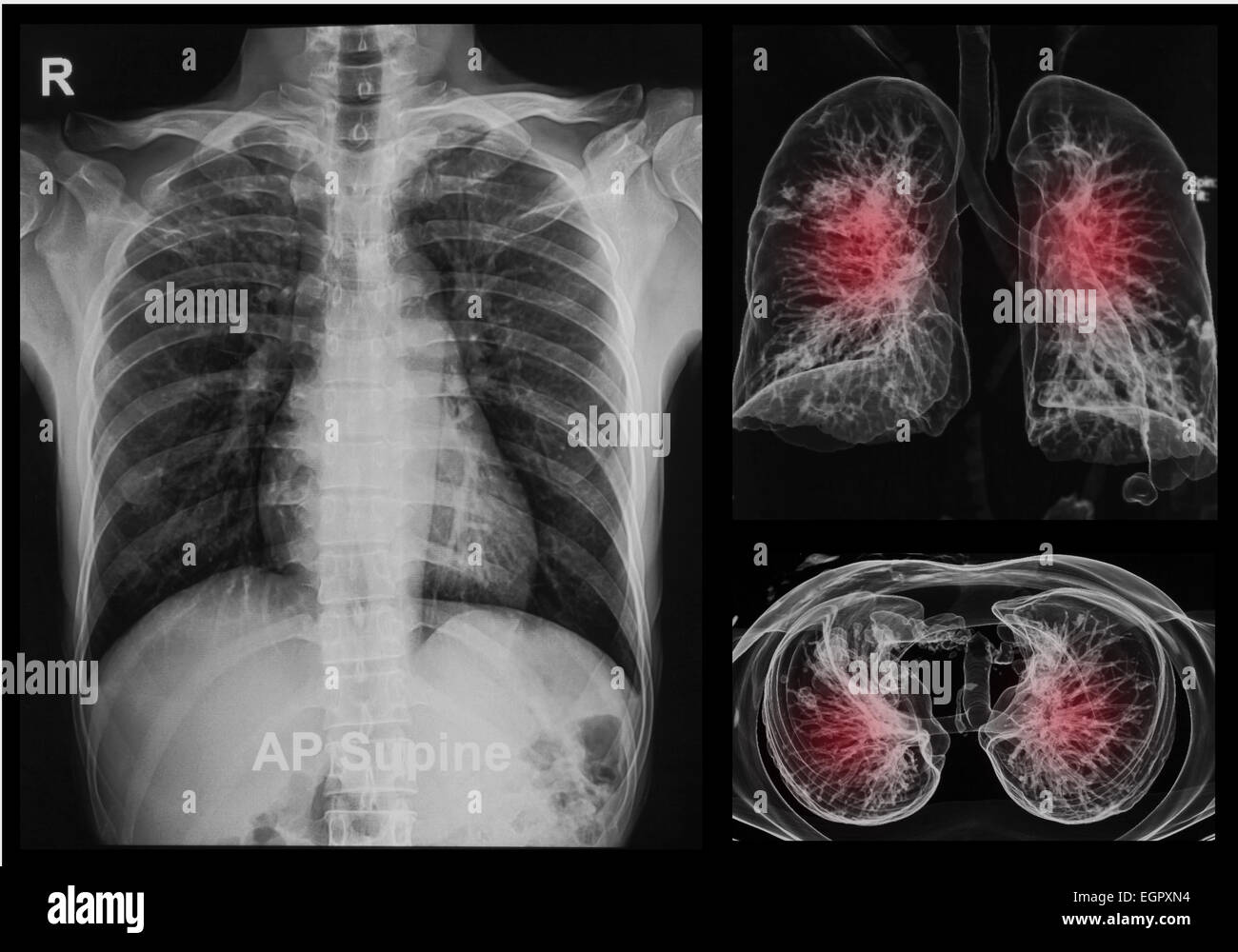 Radiografia Torace sotto immagine 3d ,polmoni immagine 3D Foto Stock