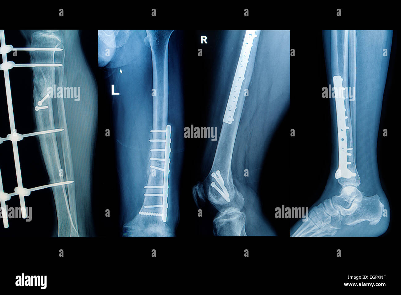 Collezione raggi x immagine dell uomo ,mostrano la frattura estremo inferiore con impianto Foto Stock