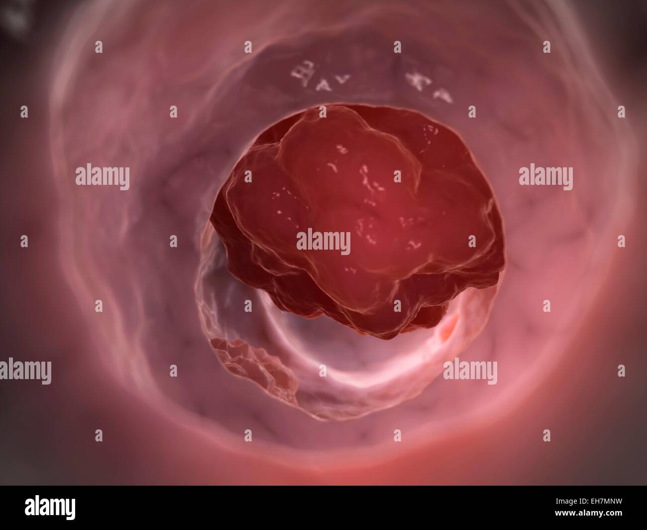 Del cancro del colon umano, illustrazione Foto Stock