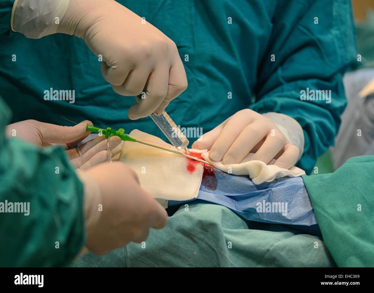 Procedura di ablazione del catetere presso il Centro clinico universitario sorella della Misericordia a Zagabria, Croazia Foto Stock