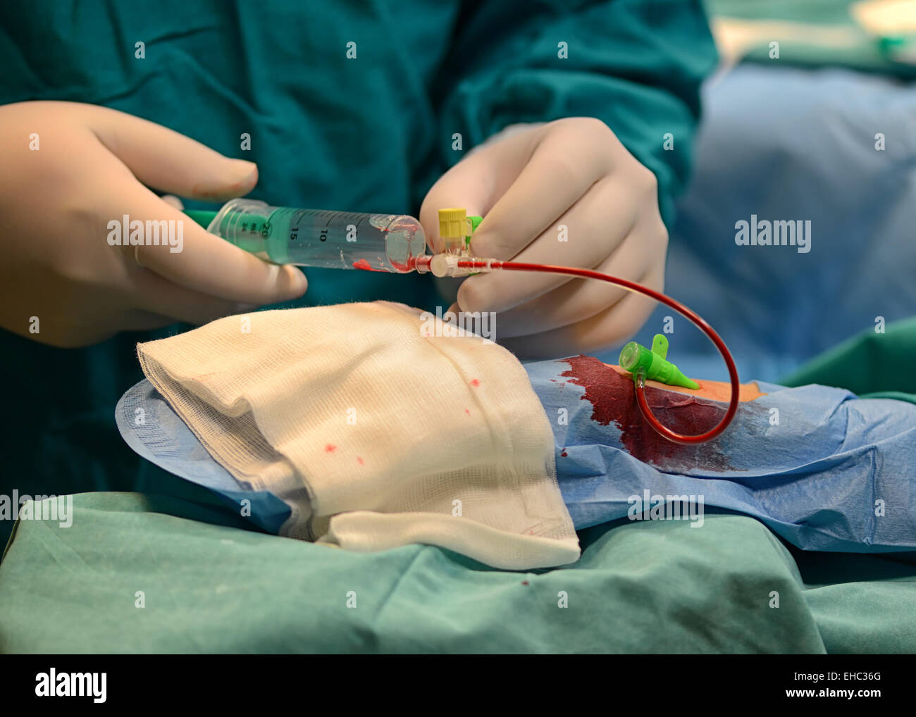 Procedura di ablazione del catetere presso il Centro clinico universitario sorella della Misericordia a Zagabria, Croazia Foto Stock