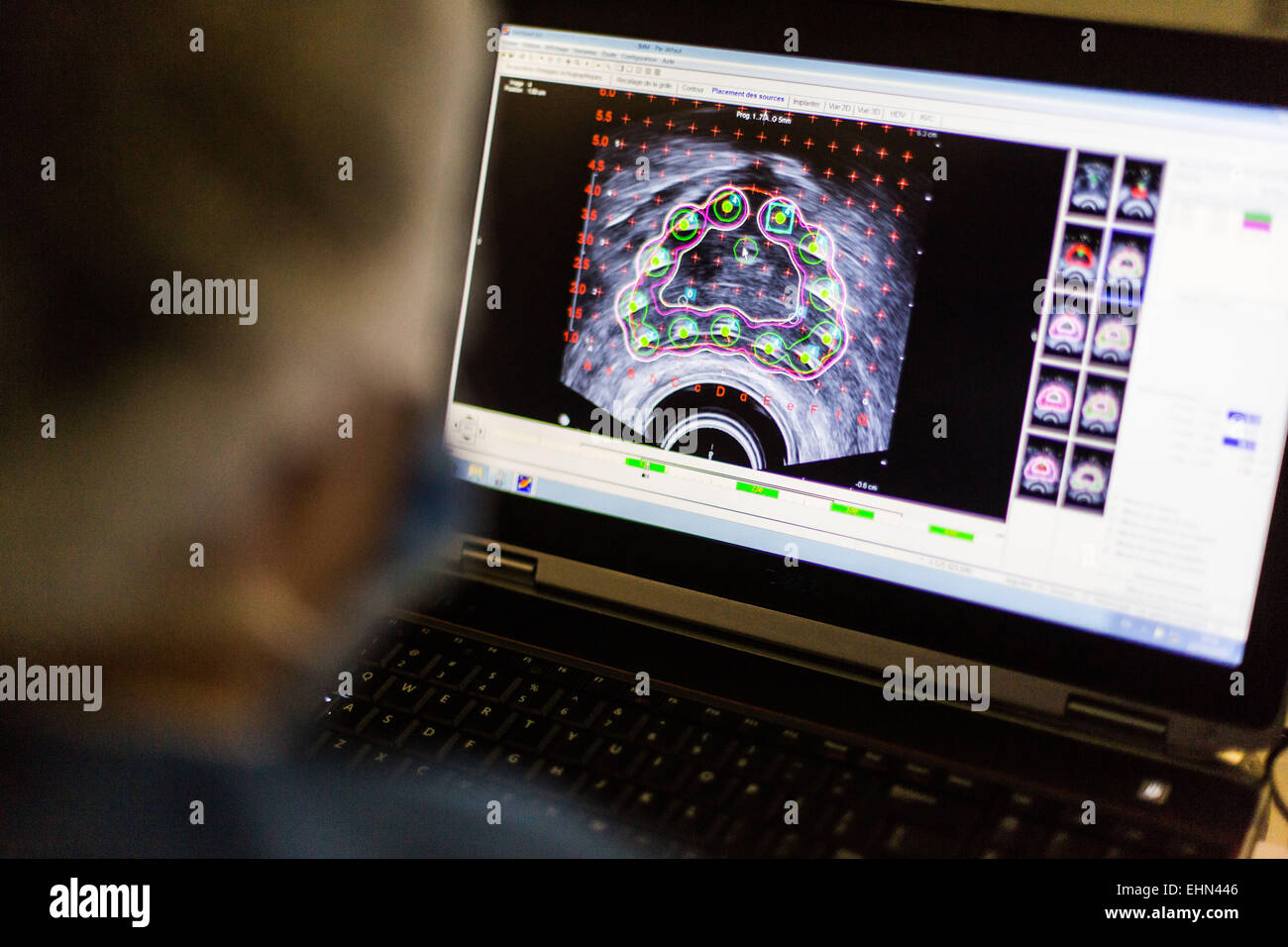 Il cancro della prostata la radioterapia chirurgia. Radiologo inserendo un ago cavo attraverso un modello a griglia (quadrato nero) e attraverso un paziente pelle perineale, durante un trattamento per il cancro della prostata. Institut Montsouris, Parigi, Francia. Foto Stock