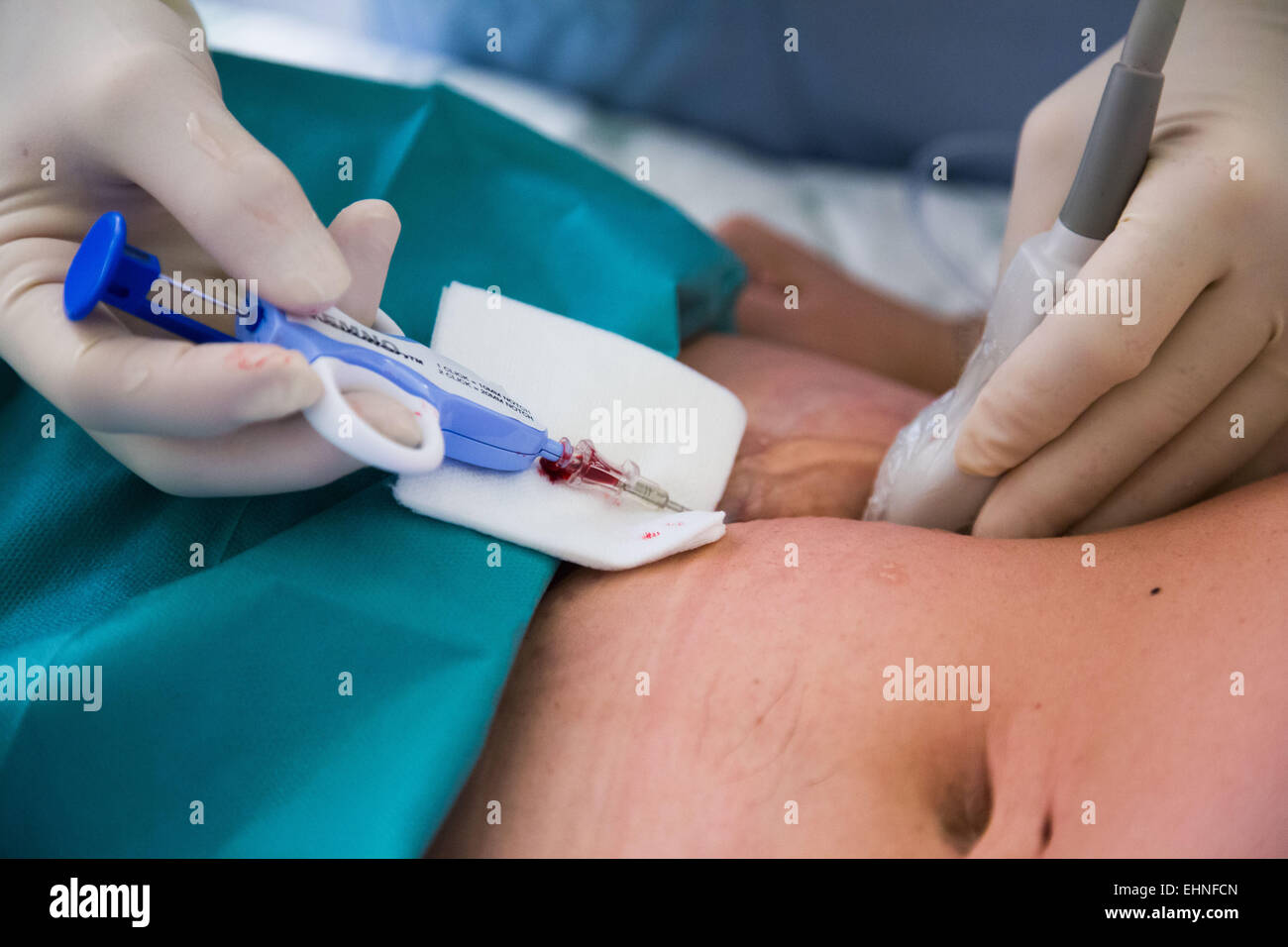 Scansione a ultrasuoni-assisted biopsia, Saint-Louis ospedale, Paris, Francia. Foto Stock
