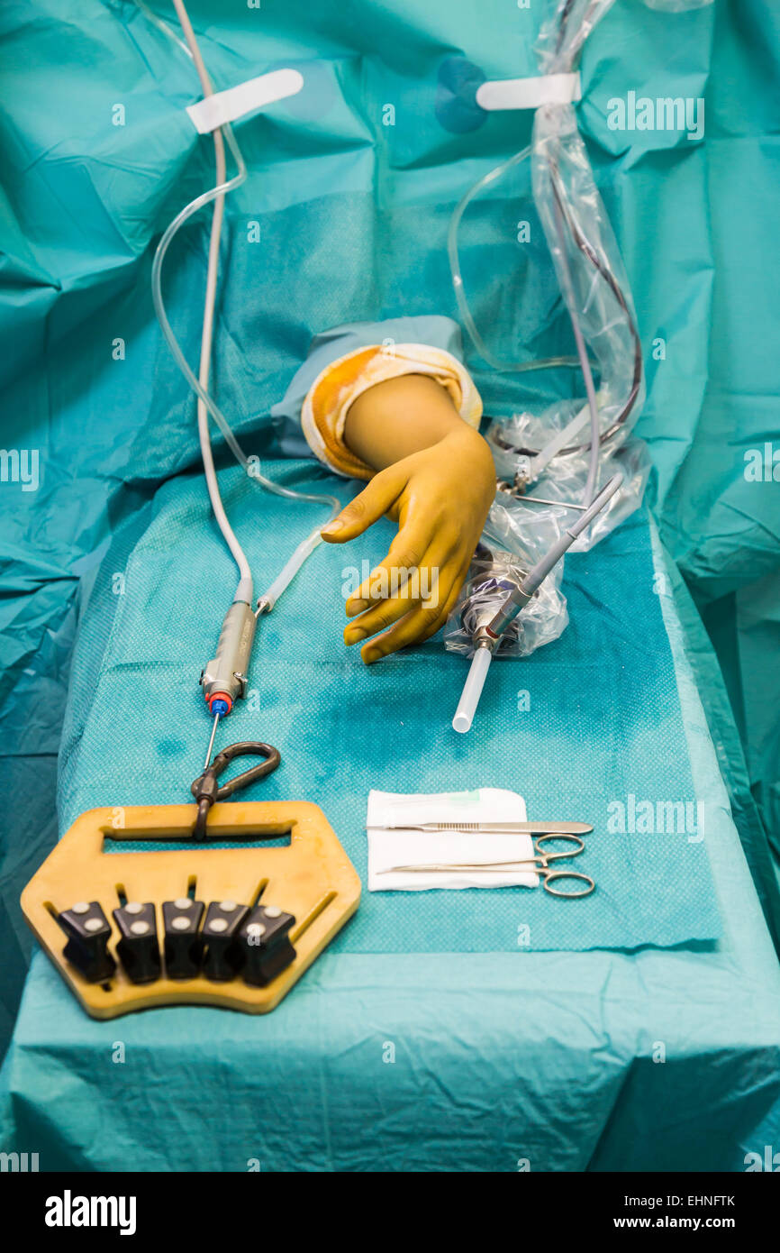 Artroscopica chirurgia del polso, Jouvenet clinic, Paris, Francia. Foto Stock