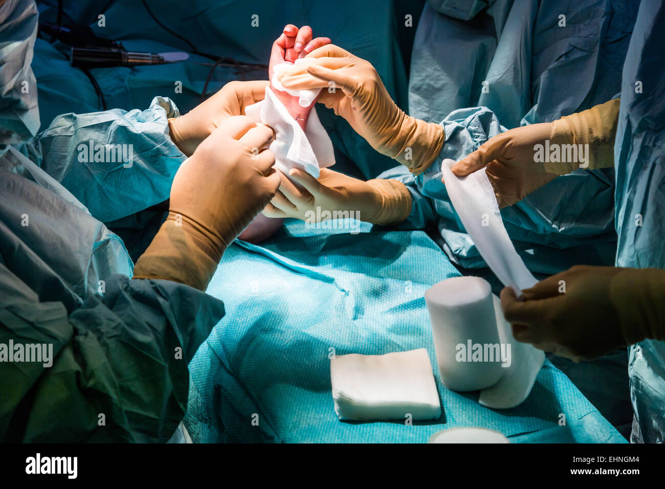 La posa di un bendaggio dopo chirurgia della mano. Foto Stock