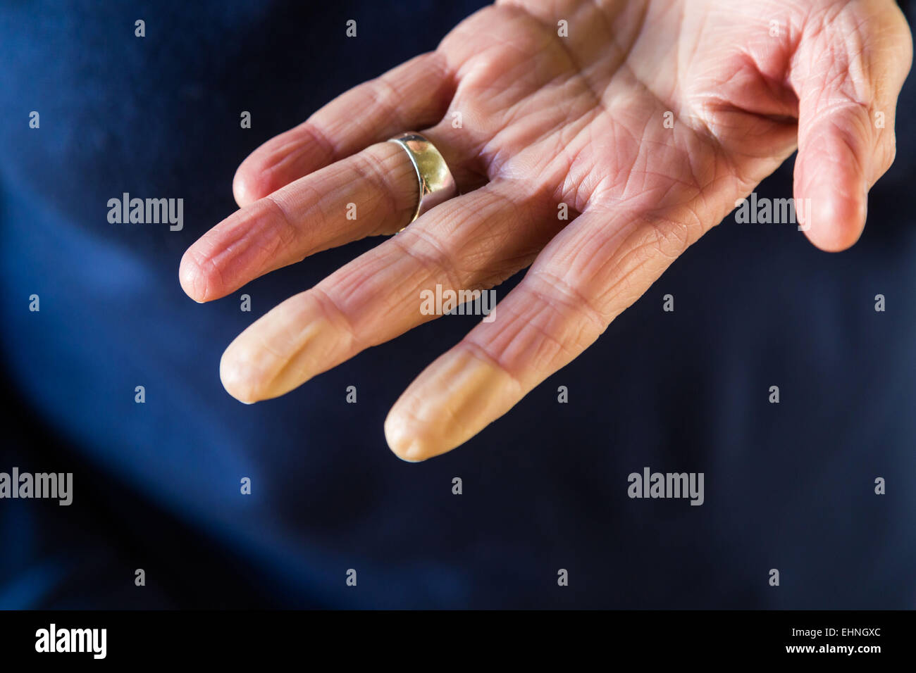 Donna di mano di una sindrome di Raynaud suffere. Foto Stock