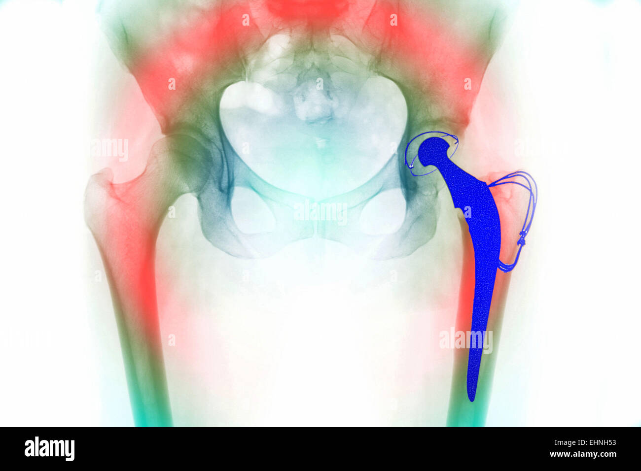 Frontale di raggi X di una totale sostituzione dell'anca , la sostituzione hip è costituito da una sfera e un albero, incorporato nel femore (thigh bone, acceso fino dal centro fondo), che si muove liberamente nella presa protesico impiantato nella pelvi . Foto Stock