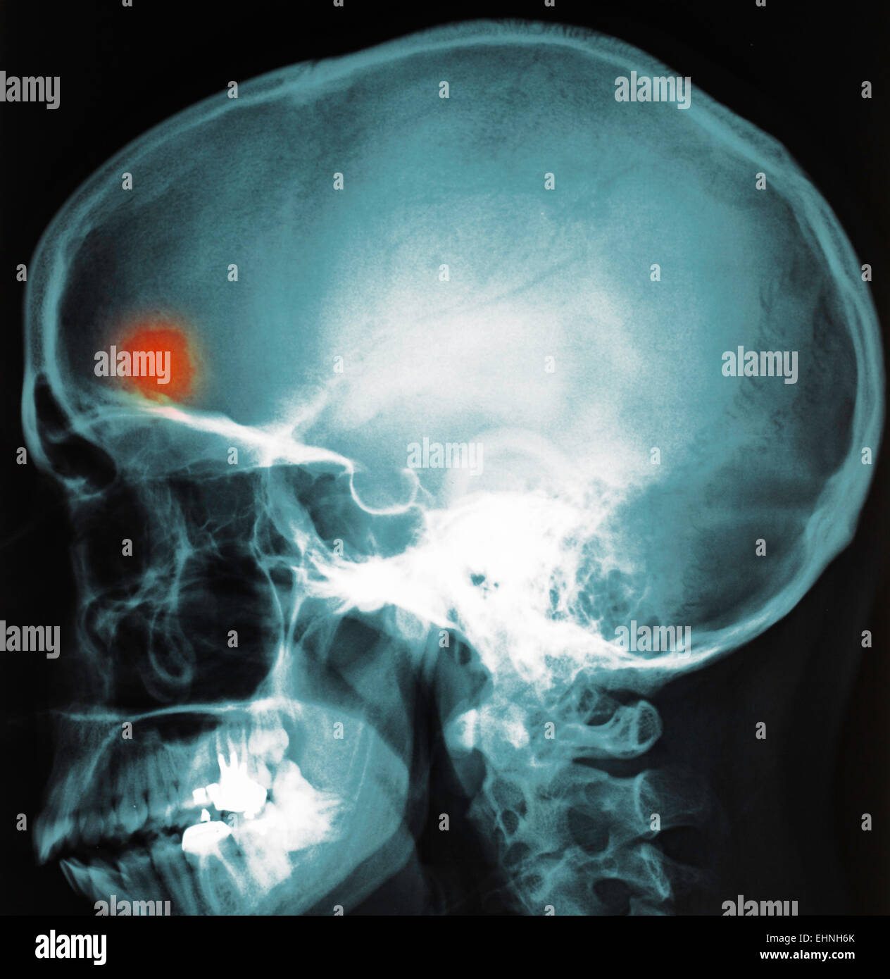 X-ray del cervello ascesso. Foto Stock