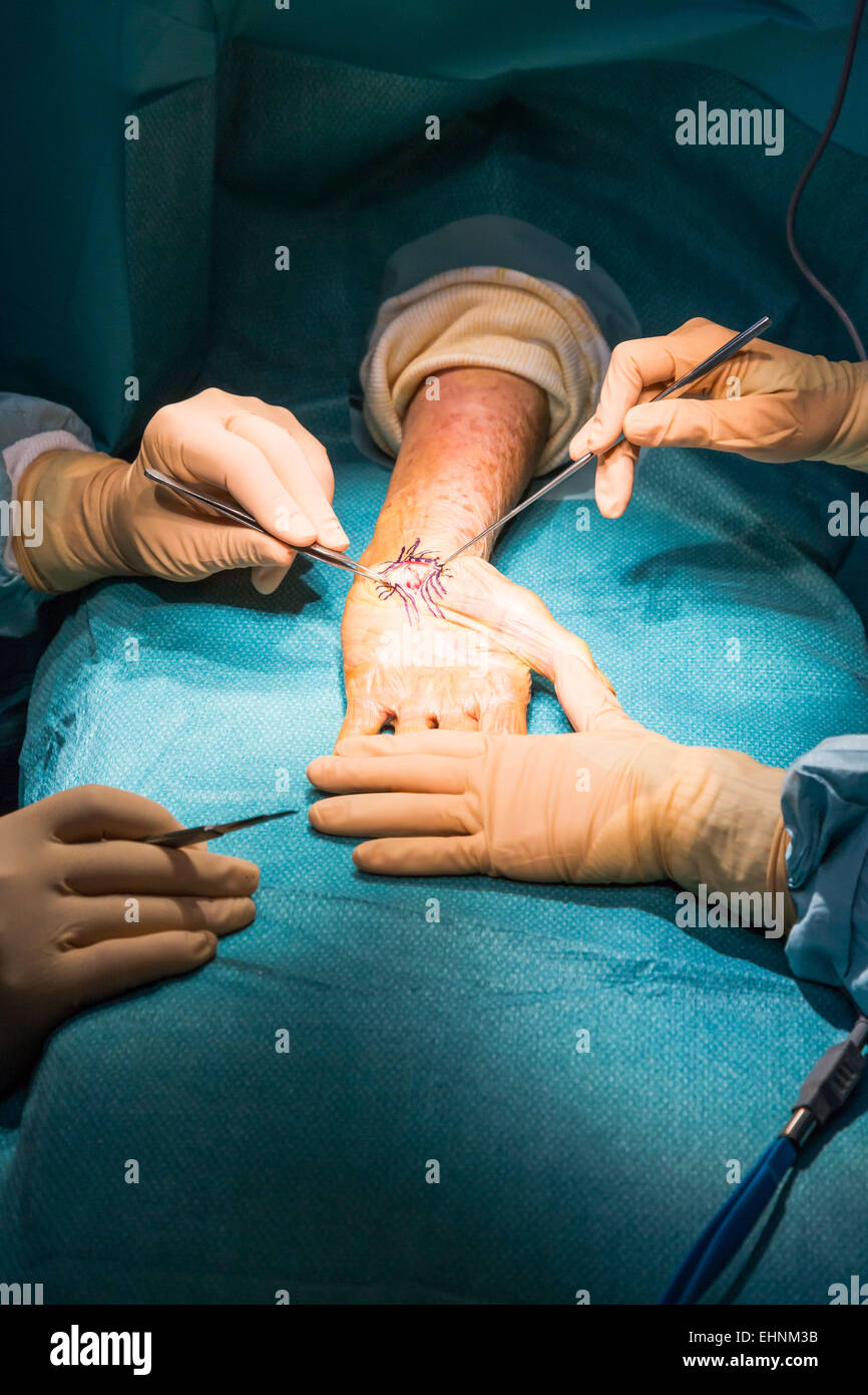 La sindrome del tunnel carpale chirurgia. Foto Stock