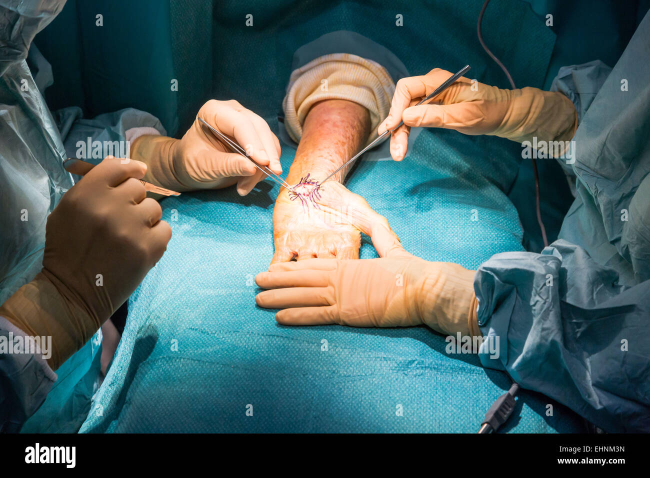 La sindrome del tunnel carpale chirurgia. Foto Stock