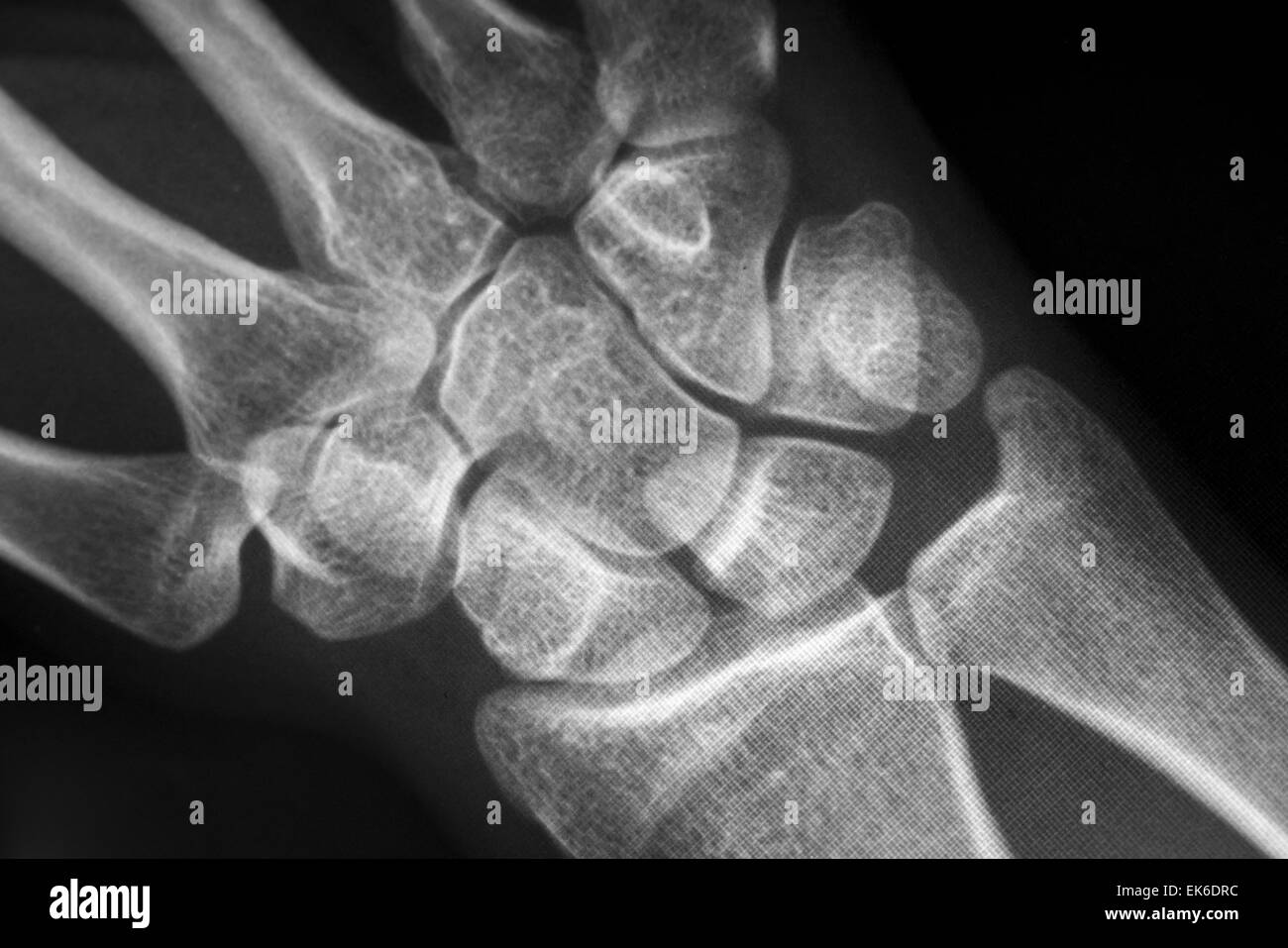 X-Ray del Carpal e ossa metacarpali in mano umana Foto Stock