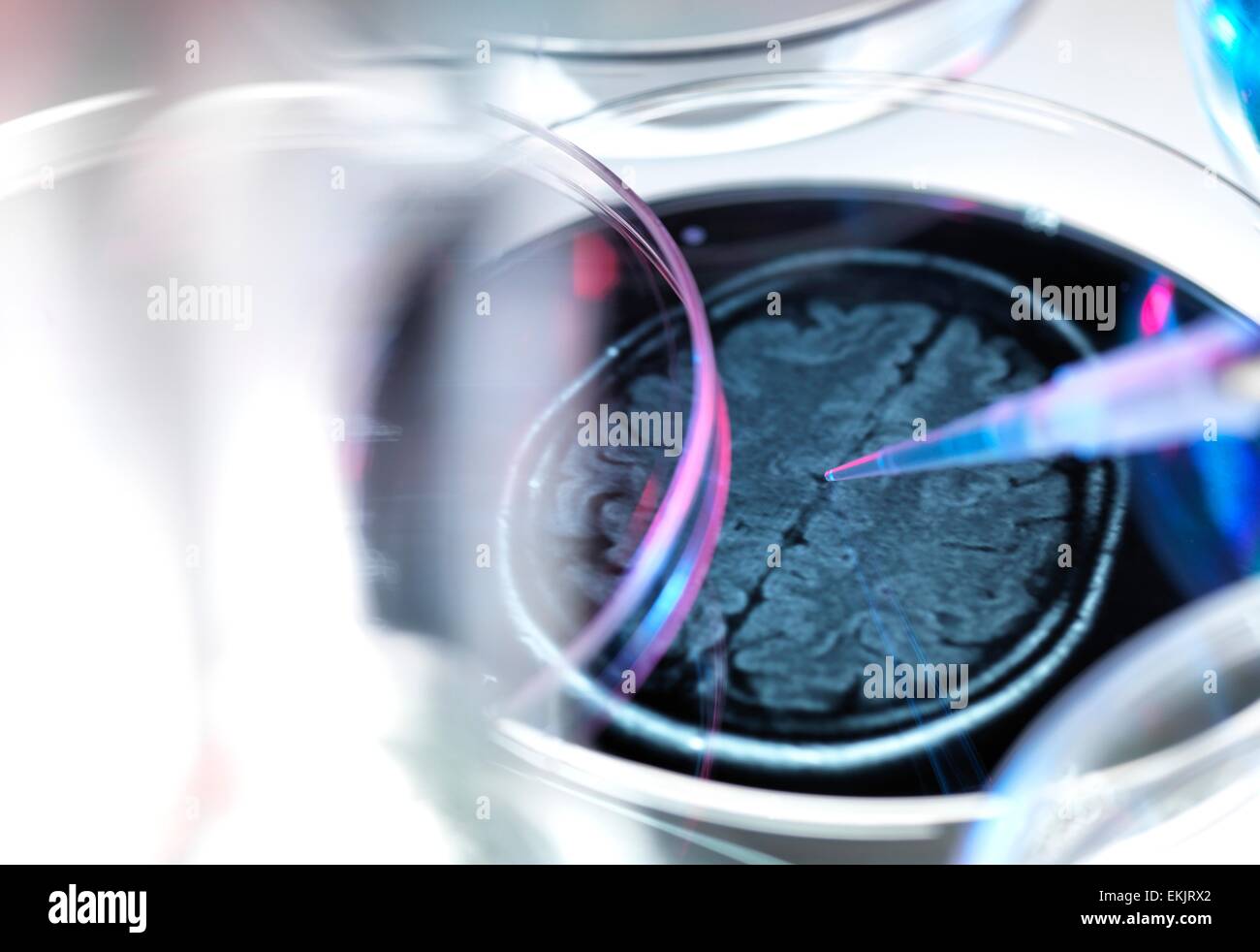 Il morbo di Alzheimer, il morbo di Alzheimer'ss malattia, malattia di Alzheimer, atrofia, cervello, la demenza, malattia, disturbo, sanitario, medico, la medicina, la demenza senile, ricerca, petri, pipetta, la ricerca farmaceutica, laboratorio Foto Stock