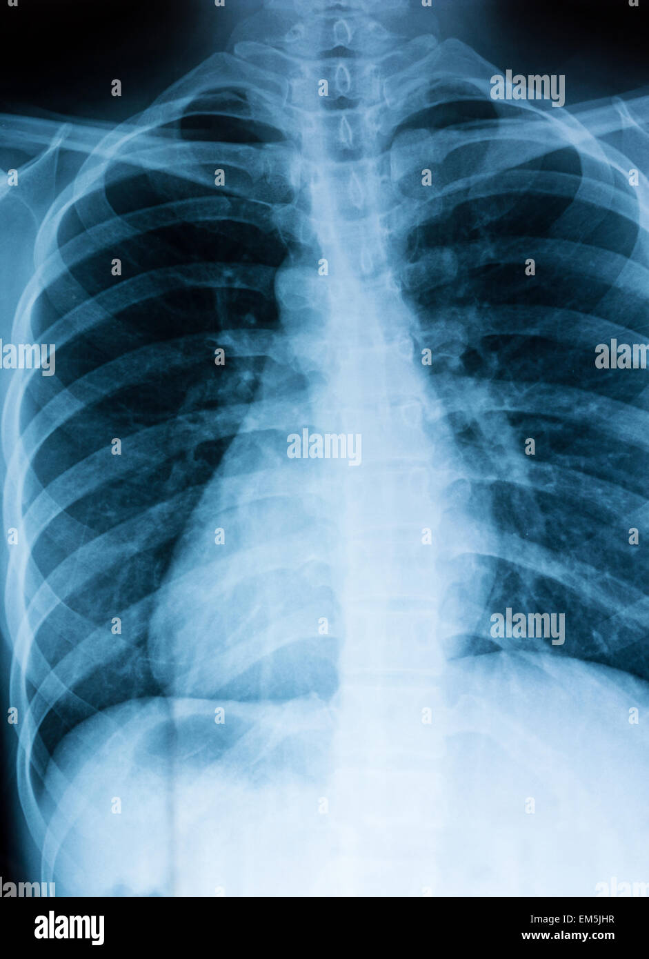 Raggi x del torace Foto Stock