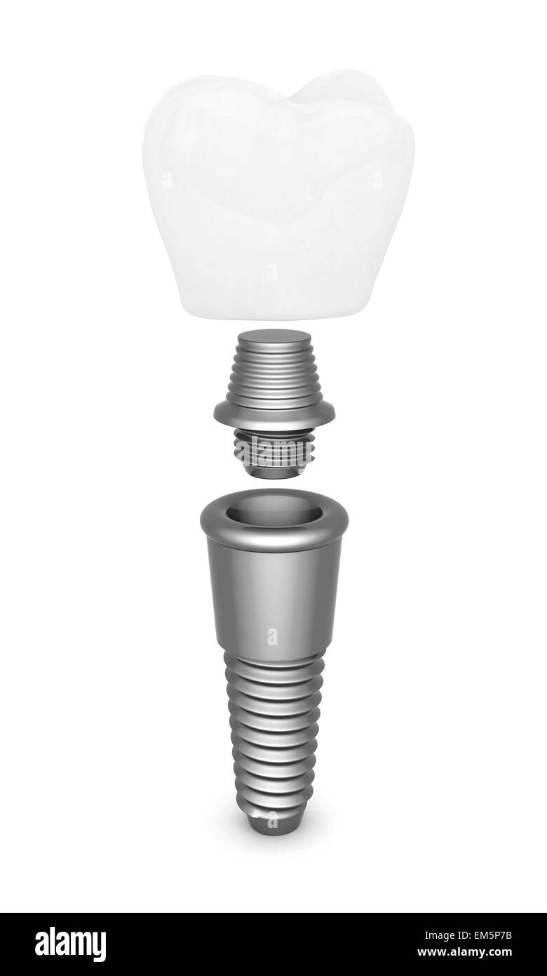 Impianto dentale Foto Stock