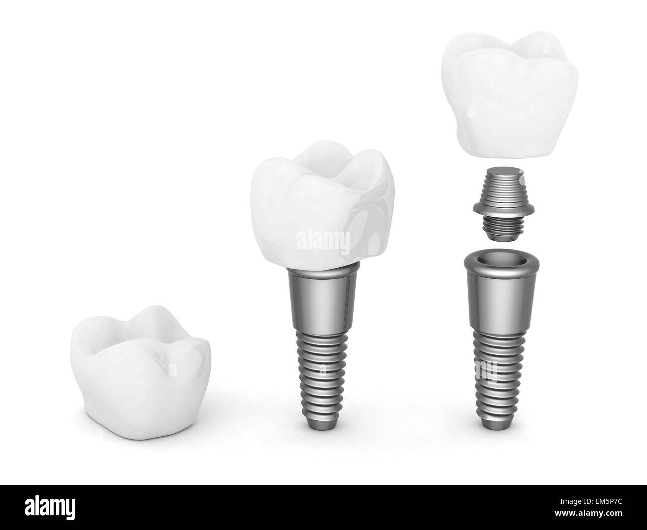 Impianti dentali Foto Stock