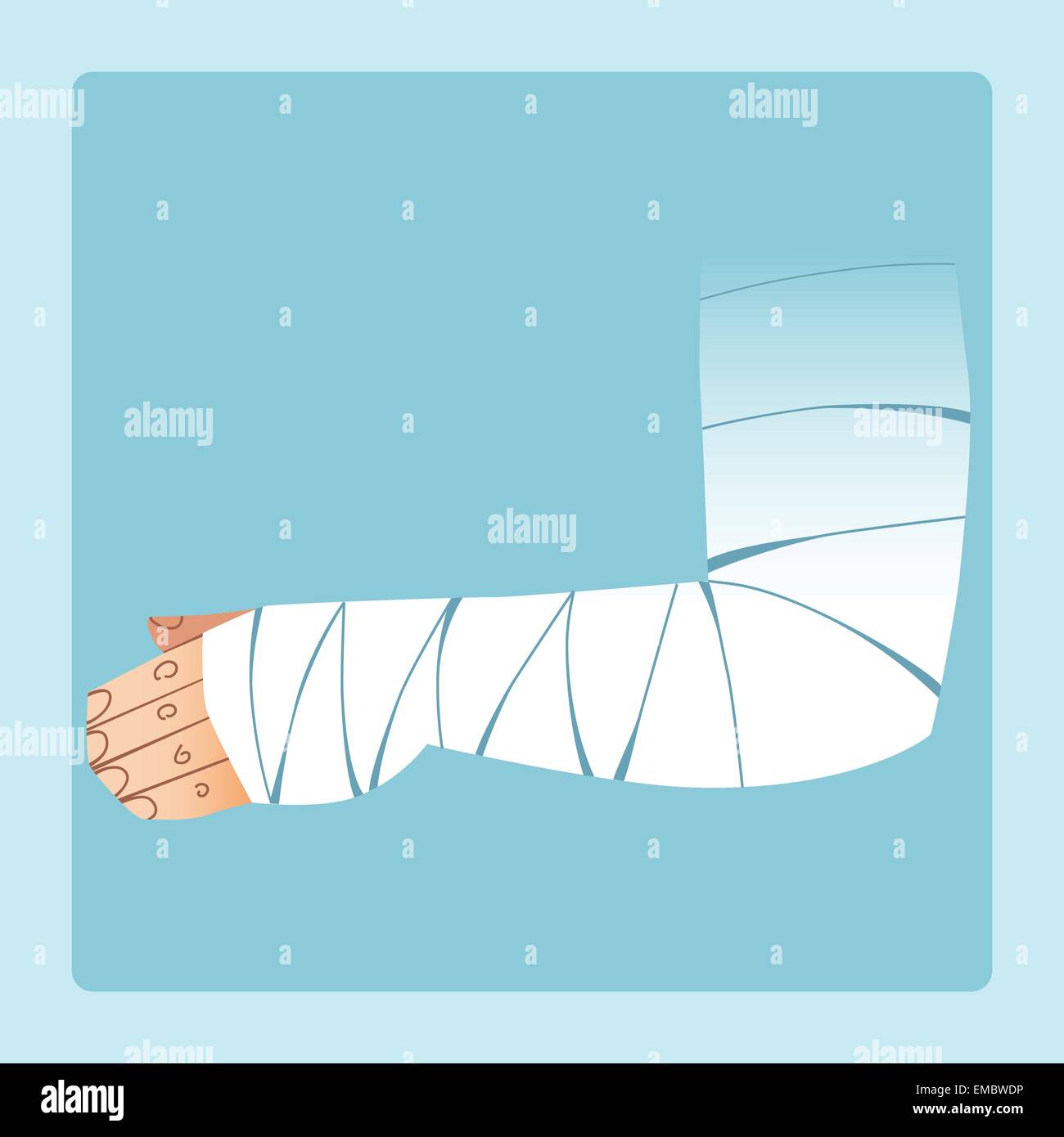 Mano bendato dopo la frattura o lesioni. Medicina e Salute Illustrazione Vettoriale