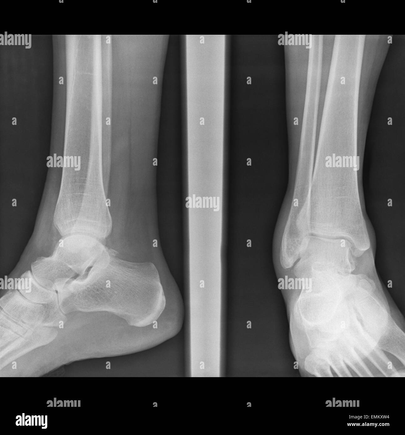 Earing di feriti capsula articolare di gambe su autentici x-ray picture frattura perone osso Foto Stock