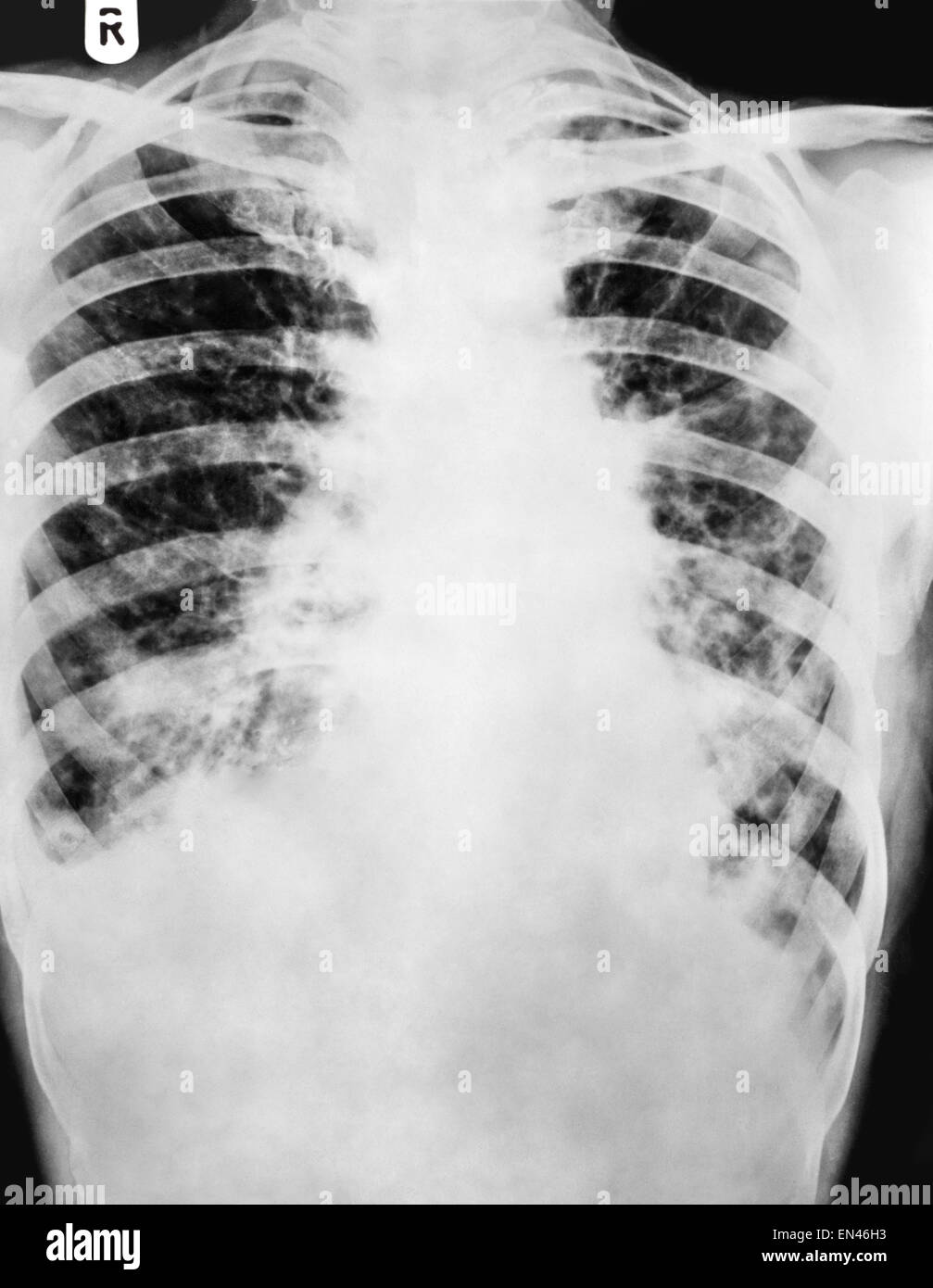 Raggi X attraverso il torace dell'uomo cavità toracica che mostra ombra sul polmone broncoectasia e ampliamento delle vie respiratorie Foto Stock