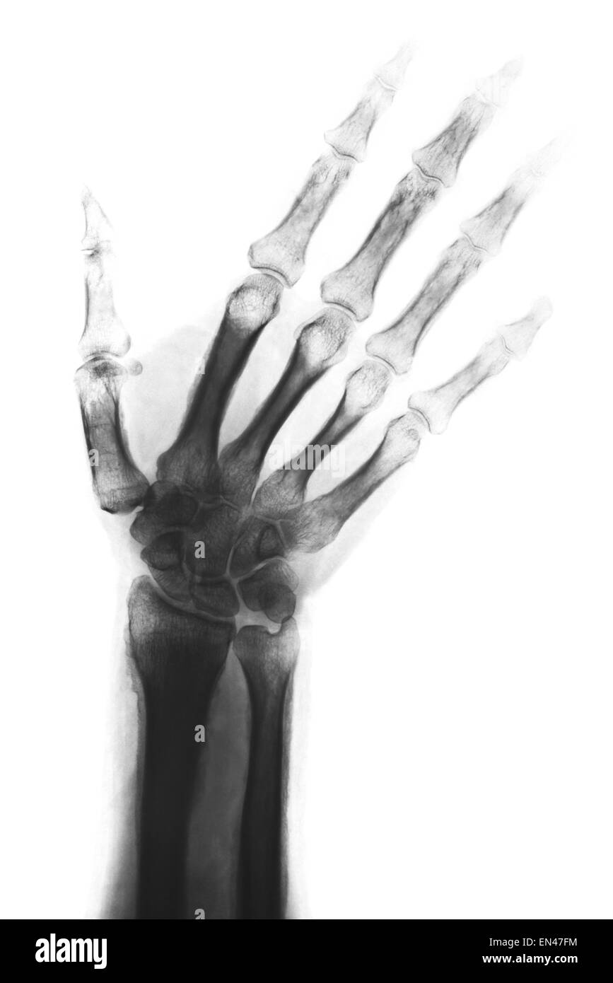 Xray attraverso adulto mano e polso con radio e ulna ossa trattamento diagnostico dita pollice Foto Stock