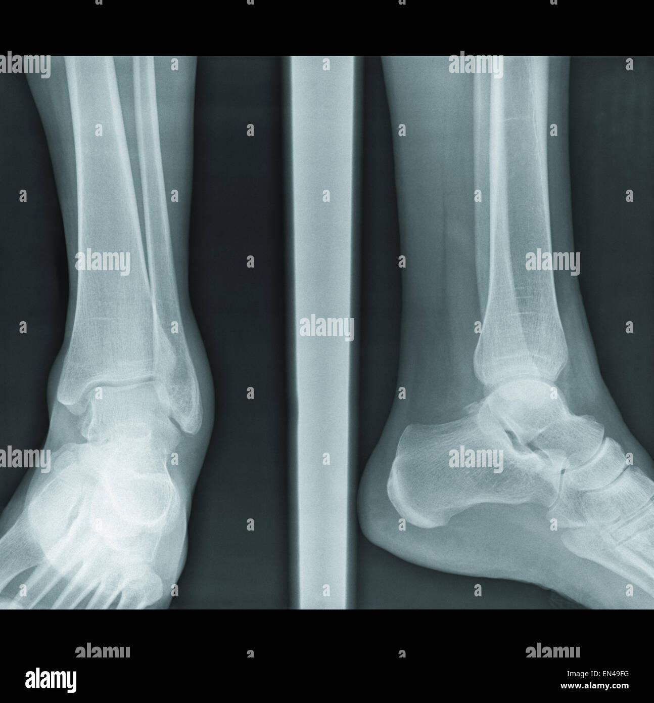 Earing di feriti capsula articolare di gambe su autentici x-ray picture frattura perone osso pregiudizio gamba comune di x-ray radiology perone Foto Stock