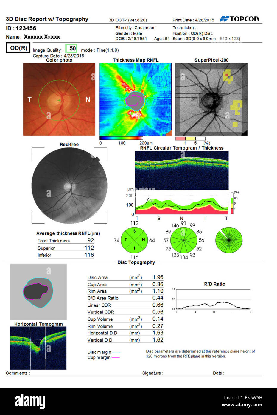 Scansione degli occhi ultra sound test mostra 3D la macula relazione dell occhio umano visitare varie rappresentazioni grafiche. Foto Stock