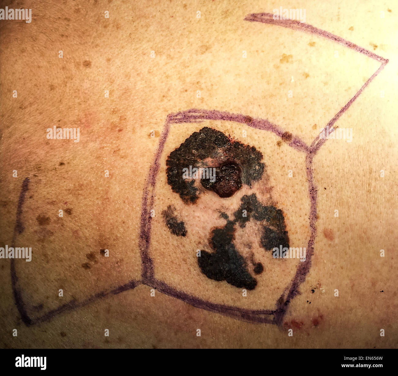 Il melanoma maligno, il cancro della pelle, preoperatory Foto Stock